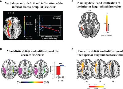 White Matter Tracts and Diffuse Lower-Grade Gliomas: The Pivotal Role of Myelin Plasticity in the Tumor Pathogenesis, Infiltration Patterns, Functional Consequences and Therapeutic Management